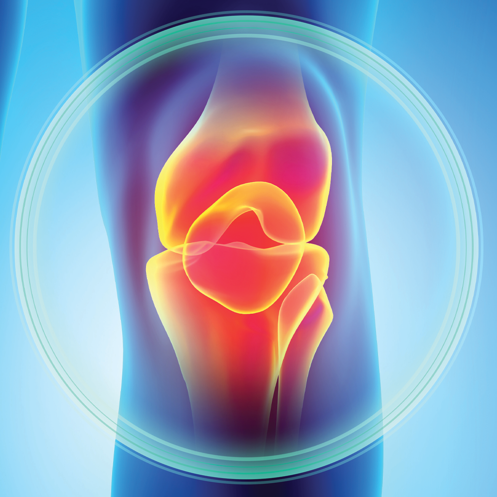 An inflamed knee joint