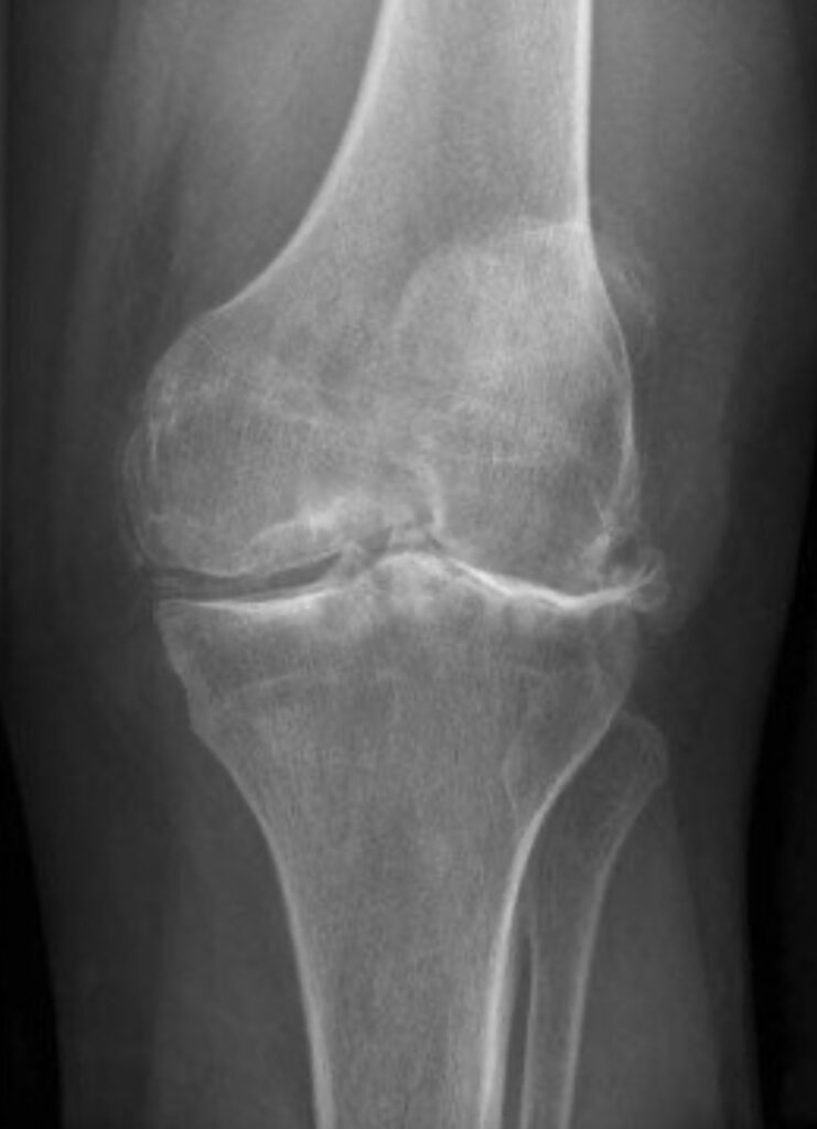 an x ray showing knee osteoarthritis
